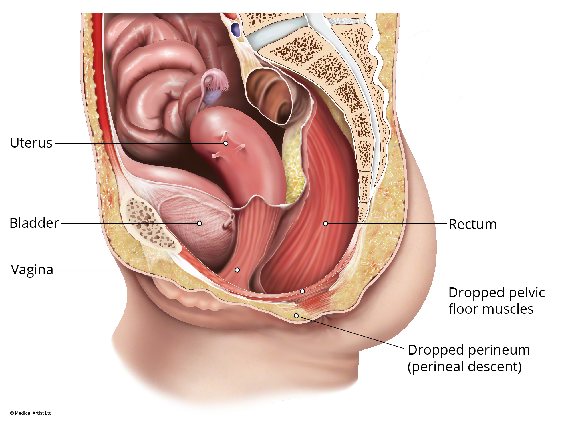 perineal hernia in women