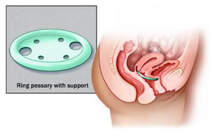 Pessary for Prolapse  Austin Urogynecology
