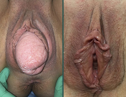 Pelvic Organ Prolapse: Something falling out of the vagina | Austin  Urogynecology